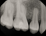 Fig 26. Periapical radiographs at 3-year follow-up showed mesialization of all first molars into the grafted extraction sockets of the second premolars. This radiograph shows the upper right as an example. Note the re-establishment of the PDL on the mesial of the first molar and minor clefting interproximally from the residual socket.