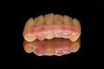 Figure  17 TRY-IN The tissue side of the definitive zirconia implant FPD. Note the natural appearance of the restoration thanks to the underlying zirconia framework.