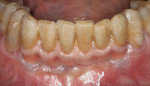 Figure  18 FINAL ADJUSTMENTS Immediate intraoral postoperative view. The restoration blended satisfactorily with the adjacent hard and soft tissues.