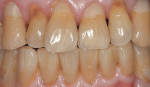 Figure  19 FINAL ADJUSTMENTS Close-up immediate intraoral postoperative view. It is hard to distinguish the prosthesis from the natural dentition.