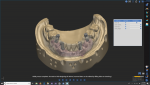 Fig 5. A completely digital 3-dimensional rendering of all levels of the model includes implants, gingiva, and both the inner and outer surfaces of the dentition.