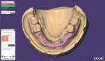 Fig 6. The soft tissue margin is outlined for each custom abutment site.