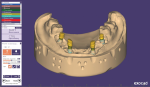 Fig 10. Specific areas of the custom telescopic abutments are smoothed.