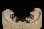 Fig 16. All abutments are placed on the master verifi ed cast after cleaning out any remaining pattern resin from the access holes.
