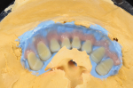 Fig 29. Gingival characterization is added, blending two shades to mimic a transitional third shade.