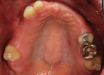 Fig 2. Evidence of patient’s prior head trauma and extensive dental treatments are shown in the pre-treatment maxillary occlusal view, pre-treatment mandibular occlusal view, and pre-treatment panoramic radiograph, respectively.
