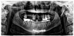 Fig 4. Evidence of patient’s prior head trauma and extensive dental treatments are shown in the pre-treatment maxillary occlusal view, pre-treatment mandibular occlusal view, and pre-treatment panoramic radiograph, respectively.