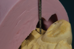 Fig 9. The restorative space over the misangled implant No. 5 is measured.
