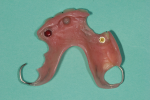 Fig 10. The patient returned to the prosthodontist after the Stage 2 surgery for an interim RPD with attachments.