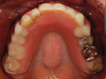 Fig 11. Shown is the occlusal view of the implant-assisted interim RPD.
