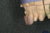 Figure 20  On the left, the desired changes in the maxillary incisors have been made in wax. The mandibular incisors have been waxed to a normal length and the articulator has not yet been closed down. On the right, the articulator is now closed until anterior contact occurs. At that point the decision can be made as to whether the anterior relationship is acceptable or not. If it is deemed acceptable, then the incisors have created the new occlusal vertical dimension and the posterior teeth would now be built into contact.