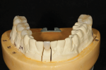 Fig 14. Restorations included PFM surveyed crowns on teeth Nos. 13 and 14; all-ceramic (zirconia) crowns on teeth Nos. 18 and 29 through 31; and a porcelain (lithium disilicate) veneer on tooth No. 25.