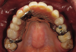 Fig 23. Post-treatment maxillary occlusal view shows the final result.