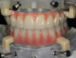 Fig 2. Here is how the milled PMMA surgical prosthesis appears after application of Ceramage UP.