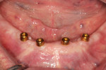 Fig 1. A patient had four implants placed in an orientation to avoid bony undercuts and critical vascular structures. Traditional stud-style abutments were used to retain a mandibular denture.