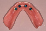 Fig 2. Angulation discrepancies result in accelerated wear on nylon inserts and implant abutments.