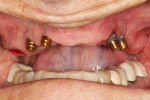 Fig 5. Traditional stud-style abutments (LOCATOR) were placed onto each implant and torqued as per the manufacturer’s recommendations. The housings were attached inside of the immediate denture using composite resin.