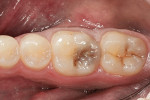 Figure  1  The patient presented with decay on the occlusal of tooth No. 19.