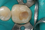 Figure  3  3M ESPE Vitrebond Plus Light Cure Glass Ionomer Liner/Base was applied to the dentin surface and light-cured.