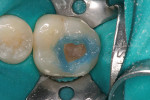 Figure  4  A phosphoric acid was applied to the enamel periphery of the preparation for 10 seconds and rinsed off.