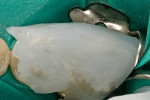 Figure  9  A thermoplastic wafer was fit into place and pressed down to mold the shape of the occlusal surface and light-cured through.