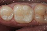 Figure  10  The final restoration shows a nearly imperceptible margin and the proper occlusal shape.