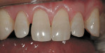 Figure  1  PRESENTATION AND PREPARATION  Preoperative photograph of a patient who requested all-porcelain crown restorations to restore the proportions to the maxillary anterior teeth and close the diastemata.