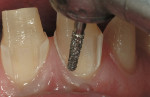 Figure  5   PREPARATION  Depth cuts are then placed with the SC856-014 in the cervical plane of the preparation. The gingival margin is established at the crest of the free gingival tissue.