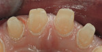 Figure  6  PREPARATION  The SC856-014 can also be used to place a depth groove in the lingual surface. This groove must follow the three anatomic planes of the lingual surface; otherwise the tooth will be under-prepared in this functional area, a com