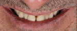 Preoperative smile and retracted view (1:2 magnification).