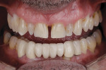 Preoperative smile and retracted view (1:2 magnification).