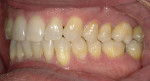 Results after 11 months of clear aligner therapy.