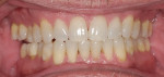 Edge-to-edge bite resulting from 5-year use of MRD.