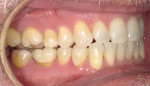 Right side, unilateral posterior open bite resulting from 5-year use of MRD.