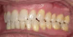 Left side, posterior edge-to-edge bite resulting from 5-year use of MRD.