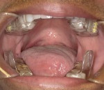 Combination therapy utilizing clear aligners in conjunction with the sleep appliance.