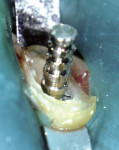 Figure  4  Fully seat flange into the dentin.