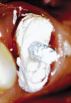 Figure  5  Use an opaquing agent for esthetic restorations.