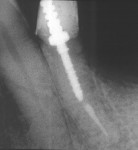 Figure  7  Final x-ray with Flexi-Flange.