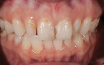 Fig 1. Preoperative close-up retracted view showing peg-shaped lateral incisors and cross-bite on tooth No. 26.