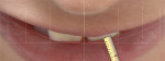 Fig 5. The 12 o’clock view photograph provided a visualization of the upper incisor positions. The central incisor edges would be moved labially 1 mm through the addition of the veneer, and the angulation of tooth No. 8 would be altered to follow the contour of the lip.