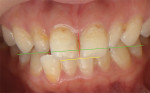 Fig 8. DSD photograph with three reference lines: midline (red), middle of incisal plane of tooth No. 8 to middle of incisal plane of No. 9 (yellow), and tip of canine to tip of canine (green). The clinician can now orient the software treatment plan to match the position of the anterior teeth.