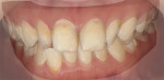 Fig 10. ClinCheck photograph superimposed with the DSD photograph to implement facially driven tooth movement.