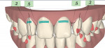 Fig 13. Representation of the final contours of teeth Nos. 7 and 10 in the software model with more mesial space than distal.