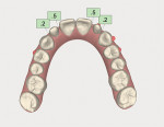 Fig 15. Occlusal view of post-orthodontic software model.