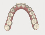 Fig 14. Occlusal view of the software model
preoperatively. Fig 15. Occlusal view of post-orthodontic software model.
