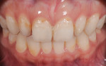 Fig 17. Close-up photograph after completion of clear aligner treatment.