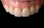 Fig 19. Postoperative close-up view of maxillary anterior teeth.