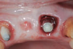 Fig 4. Incisal view of immediately placed 5-mm x 2-mm titanium transfer abutment.