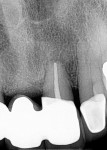 Fig 2. Radiograph of maxillary left central incisor, pretreatment.